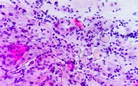 mild inflammation on pap smear|Inflammation on the Cervical Papanicolaou Smear: Evidence for .